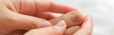 Fungal infections and minor nail injuries